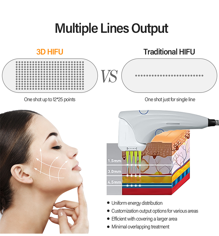 Tradiontal Hifu Comparison of 4D 3D HIFU technology